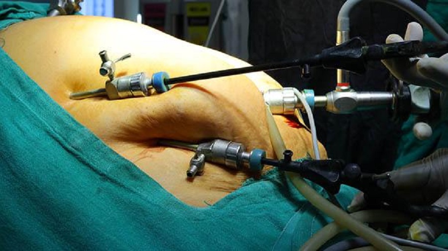 Gallbladder Removal Surgery